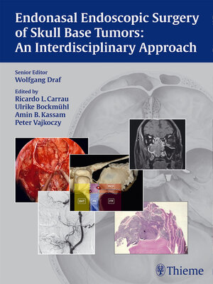 cover image of Endonasal Endoscopic Surgery of Skull Base Tumors
